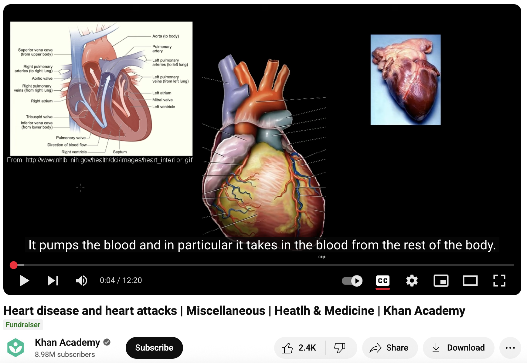 Heart Disease and Heart Attacks Instructional Video