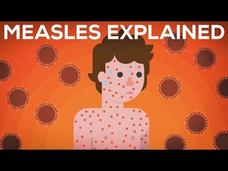 Measles Explained—Vaccinate or Not? Instructional Video