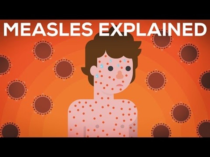 Measles Explained—Vaccinate or Not? Instructional Video