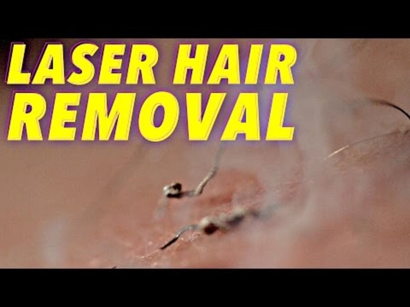 Science of Laser Hair Removal in SLOW MOTION Instructional Video